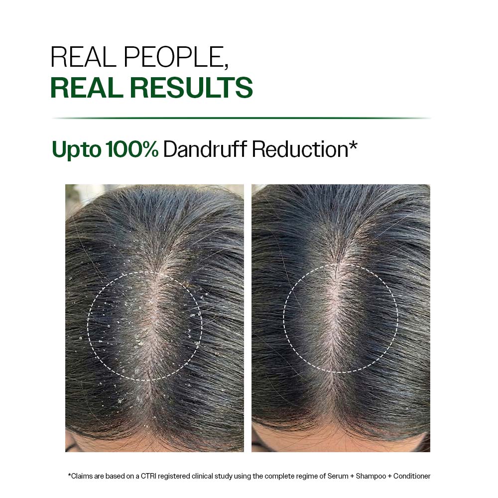 Bare Anatomy Expert Anti-Dandruff Shampoo Targets Oily Scalp And Sheds Dry Flakes Clears away dandruff flakes Relieves from excessive oil 8.4 Ounce