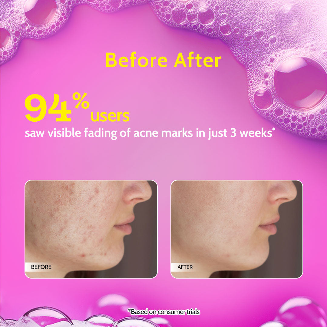 2% Salicylic Acid Face Wash for Acne & Oil Control - 100 ml